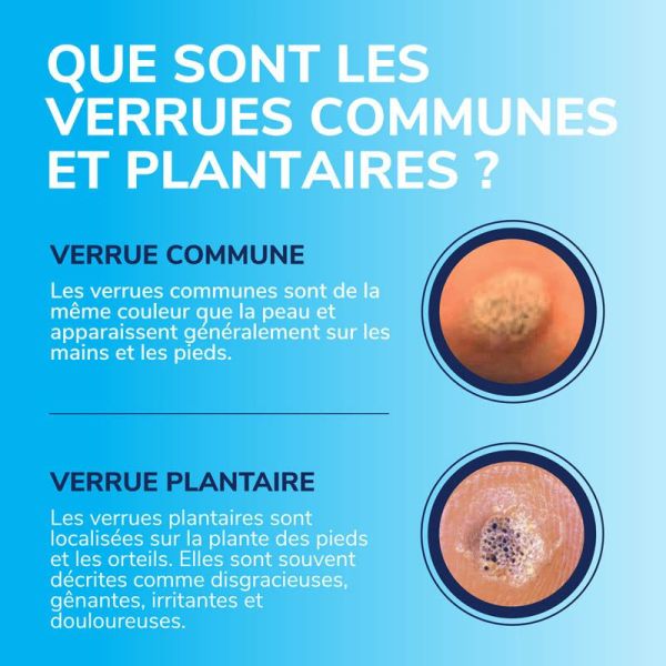 Scholl Traitement Verrues Pieds & Mains - 35 ml - Élimination rapide des verrues par cryothérapie