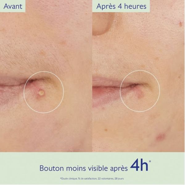 Caudalie Vinopure Stop Boutons Salicylique 15ml – Pureté et fraîcheur