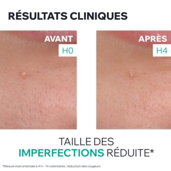 Uriage Hyséac Gel SOS Asséchant 15 ml - Effet patch invisible contre les boutons