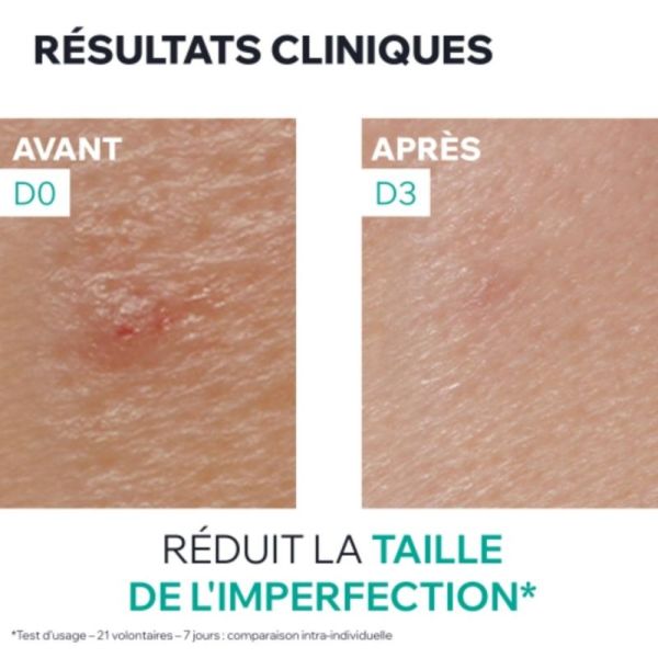Uriage Hyséac Pâte SOS 15 ml - Accélère la disparition des boutons dès la première nuit